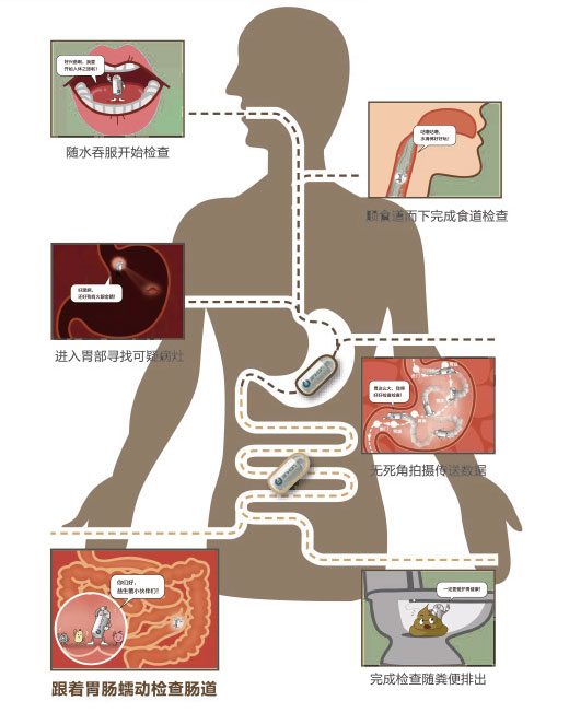 胶囊胃肠镜检查示意图
